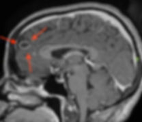 meningioma cistico