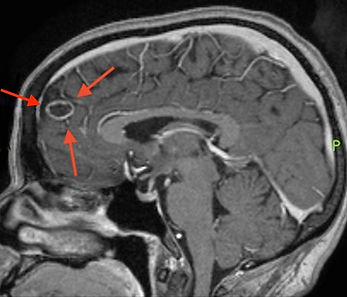 meningioma cistico