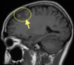 RM de cavernoma cerebral superficial