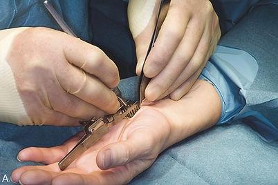 cirurgia na sindrome do tunel do carpo