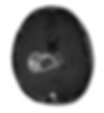 GBM - glioblastoma multiforme - rm