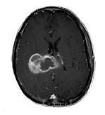 GBM - glioblastoma multiforme - rm