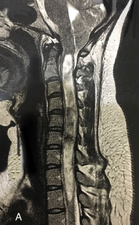 Serigomielia, ressonancia magnetica cervical