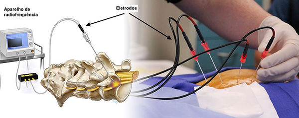 rizotomia radiofrequencia - tecnica e aparelho.jpg