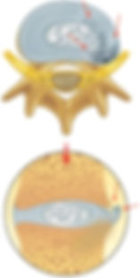 Degeneração do disco intervertebral
