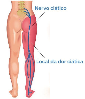 Nervo ciatico dor