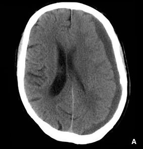 Tomografia computadorizada do hematoma subdural crônico