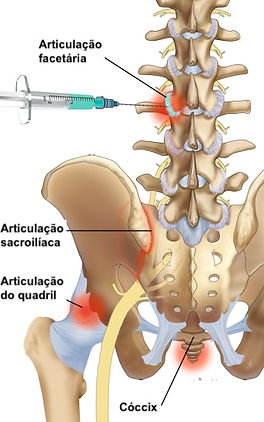 infiltraçao_e_desnervaçao_coluna_lombar