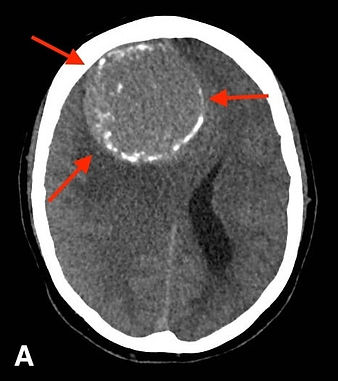 Meningioma gigante cerebral