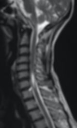 rm cervical seringomielia