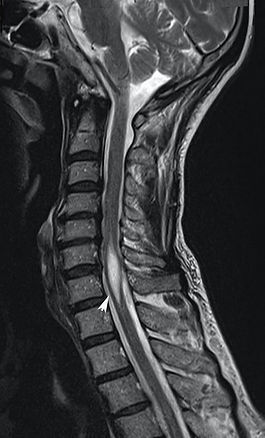 rm cervical seringomielia