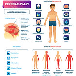 Is-Cerebral-Palsy-Reversible-scaled.jpg