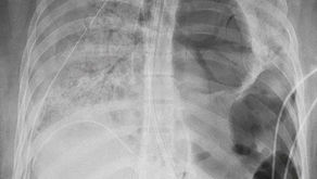 Impactante: le trasplantan los dos pulmones a joven de 20 años por el Covid-19