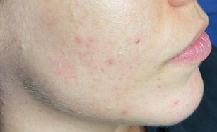 4 Monate nach der 5. Microneedling Behandlung