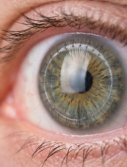 Person's_eye_after_corneal_trans…_202609011138.jpeg