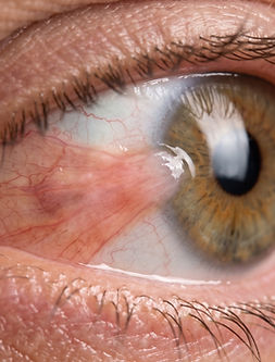 Eye_with_pterygium_growth_2K_202609011129.jpeg