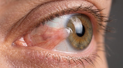 Eye_with_pterygium_growth_2K_202609011129.jpeg