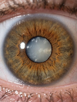 Eye_showing_visible_cataract_lens_202609011127.jpeg