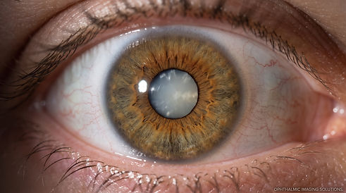 Eye_showing_visible_cataract_lens_202609011127.jpeg