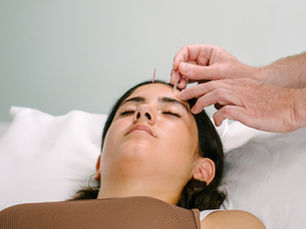 Cosmetic Facial Acupuncture