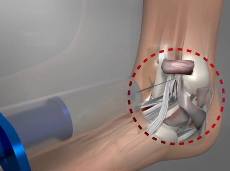 Hematoma Block