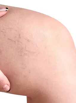 varicose veins in women.webp