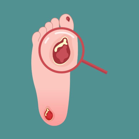 ¿Qué es una úlcera por presión (UPP)?. Lo que debes saber sobre ellas