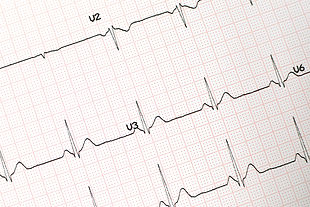 ECG.jpg