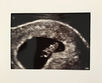 The Reality of Miscarriage