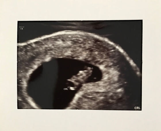 The Reality of Miscarriage