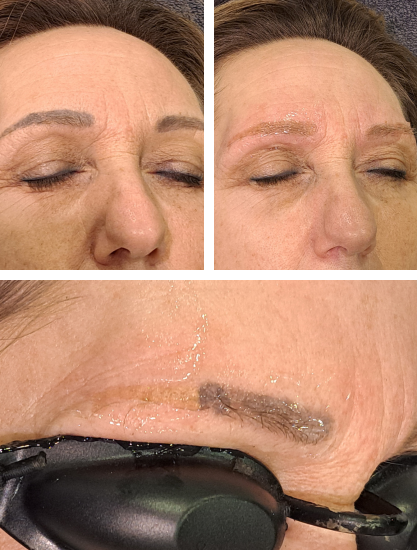 Laserbehandeling Tongeren | Skin Secrets