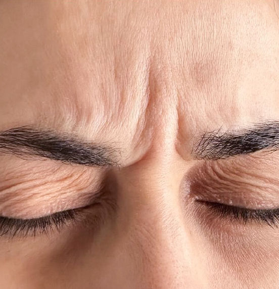 botox zonas de aplicacion-56.jpg