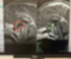 MRI Comparison | Left: July & Right: September Post Op