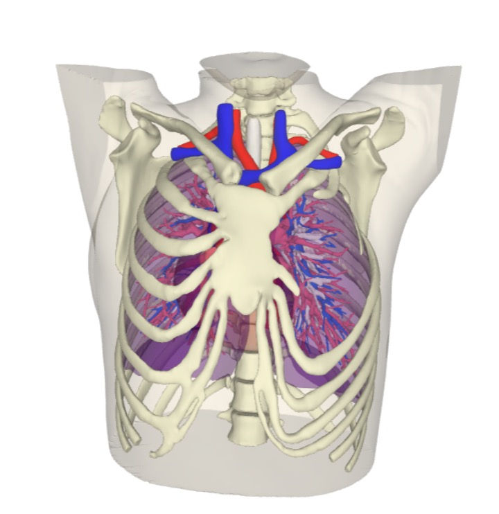 3D reconstruction image of Poland Syndrome