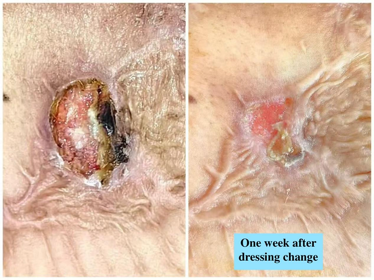 chest wall infection: before and after