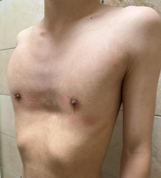 pectus excavatum