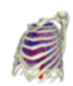 3D Reconstruction of barrel chest