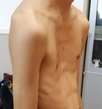 high-positioned pectus excavatum