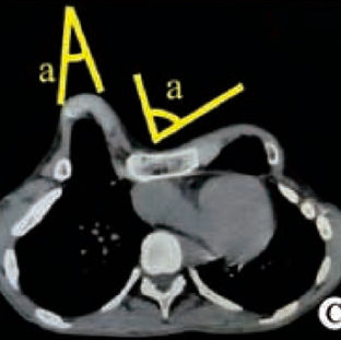 什么是锐角畸形？
