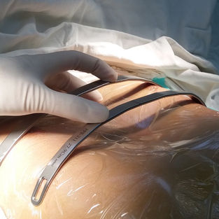 3 Minimally Invasive Surgeries for Pectus Excavatum