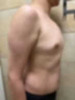 barrel chest patient