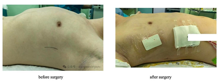 Before and after surgery comparison of a patient with barrel chest