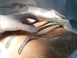 漏斗胸的3种微创手术方式