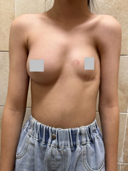 患有Poland综合征的女性患者