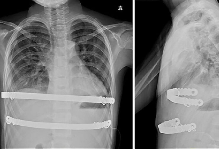 Bars implanted inside the body during the Nuss procedure.