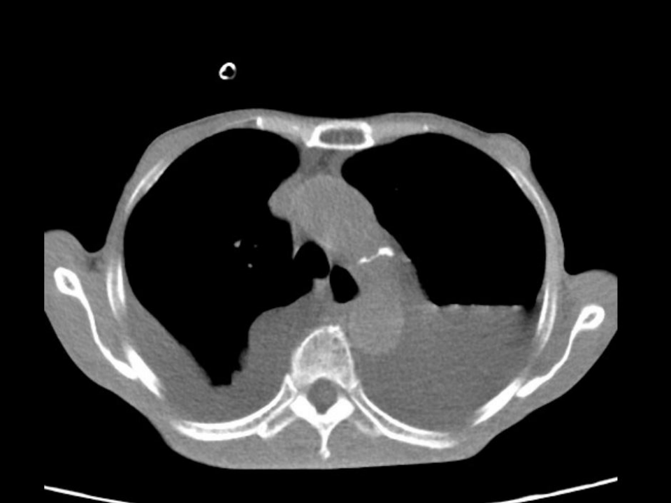 胸部&nbsp;CT 显示乳糜胸患者双侧胸腔大量积液