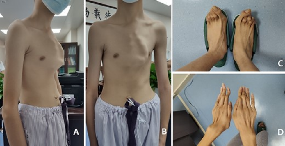 complex chest wall deformities