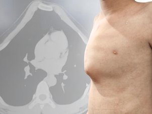 关于鸡胸手术你需要知道的事