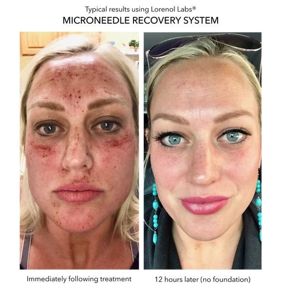 Microneedle Results 