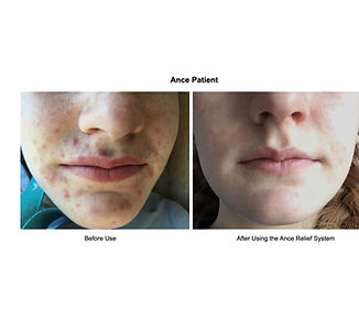 Acne Photos